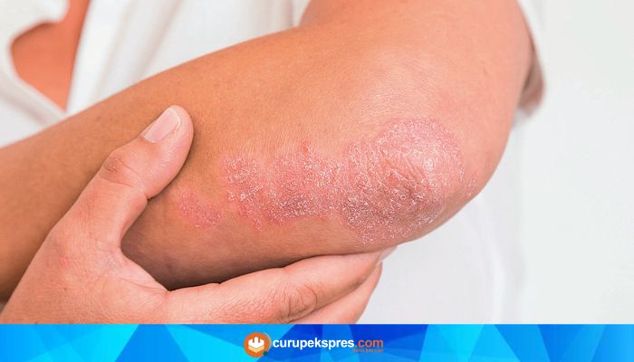 Waspada Psoriasis! Prevalensi di Indonesia Capai Hingga Ratusan Ribu