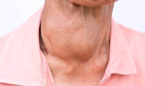  Jangan Anggap Sepele! Ini Tanda-Tanda Hipotiroid yang Perlu Diwaspadai