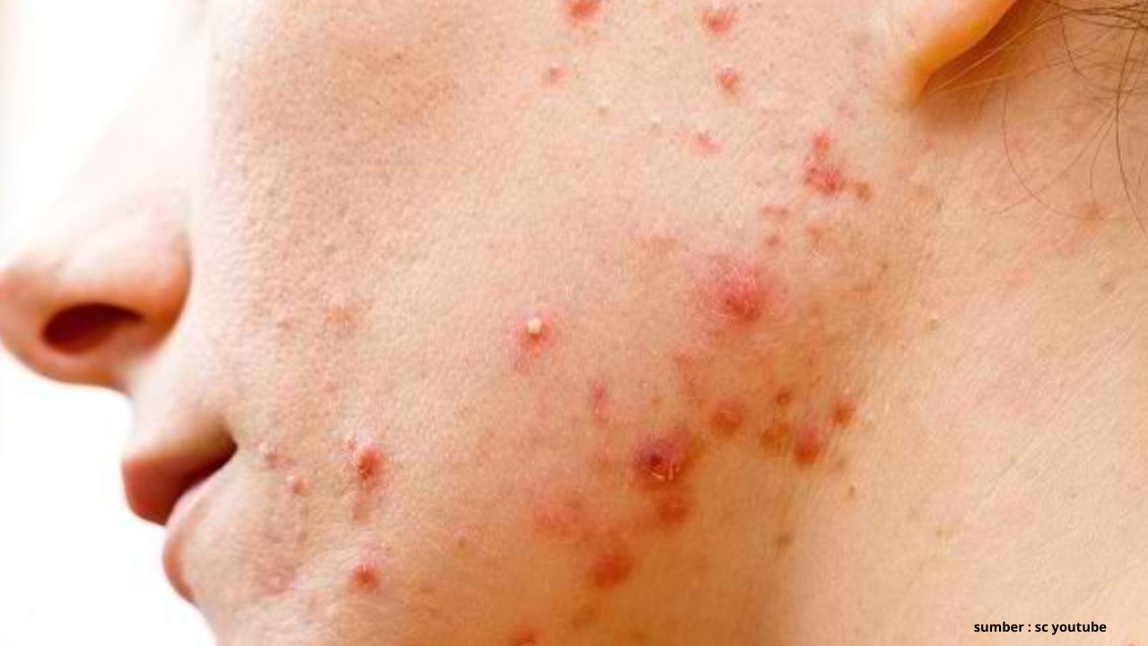 Catat! Ini 3 Tips Menghindari Maskne atau Jerawat Karena Penggunaan Masker