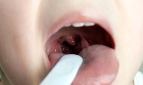 Radang Amandel Sering Menyerang Anak, Ini Penjelasan dan Penanganannya