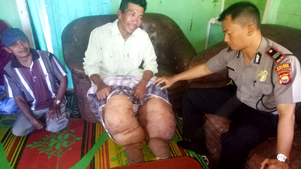 Warga Air Meles Atas Derita Kaki Gajah