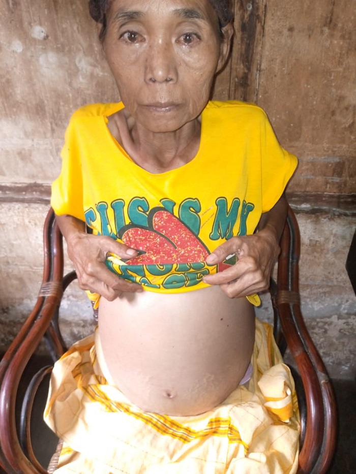 Penderita Ascites Butuh Bantuan