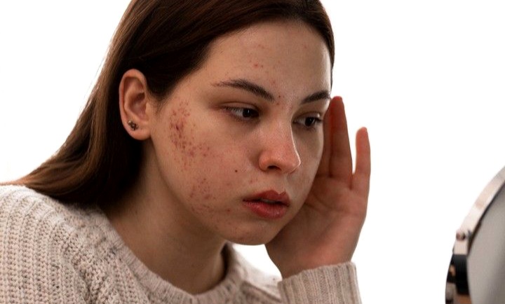 Kulit Berminyak dan Berjerawat ? Hindari 5 Bahan Ini agar Wajah Lebih Sehat