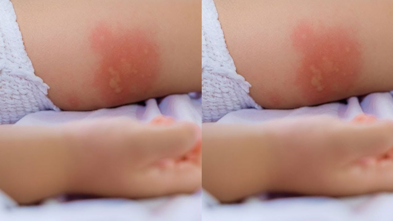 Cara Menghilangkan Ruam Pada Bayi Karena Popok, Tips Ini Wajib Orang Tua Ketahui