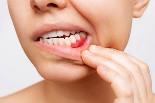 Ketahui Penyebab Gigi Bergeser dan Apa yang Harus Dilakukan?