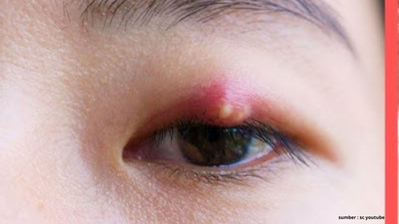 Catat! Ini 3 Penyebab Utama Mata Bintitan yang Harus Kamu Ketahui