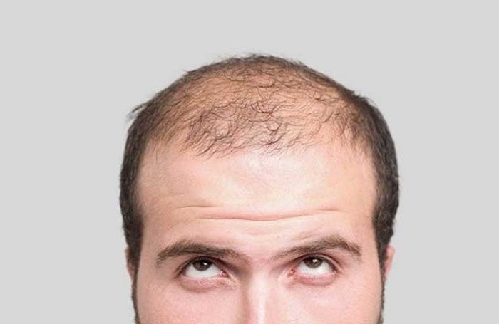 Kepala Kalian Botak? Apa Penyebab Kepala Botak? Cek Artikel Berikut!
