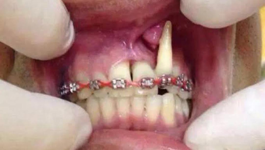 Bahaya Memakai Behel ke  Tukang Gigi  Abal-Abal !!!