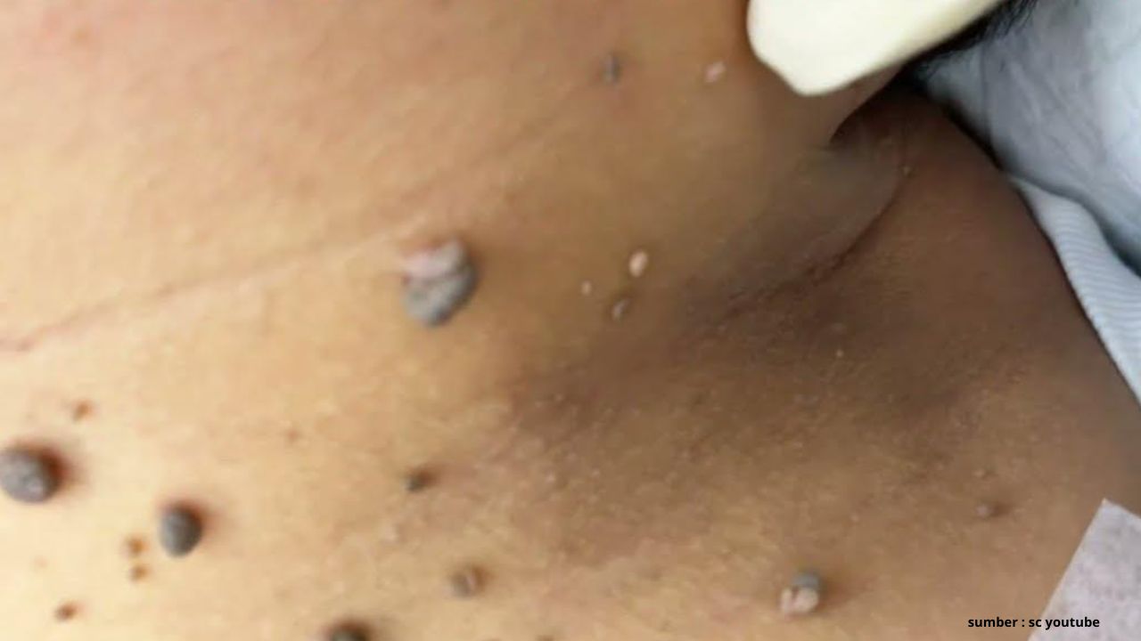 3 Bahan Alami yang Bisa Mengatasi Kutil di Leher, Cek Disini!
