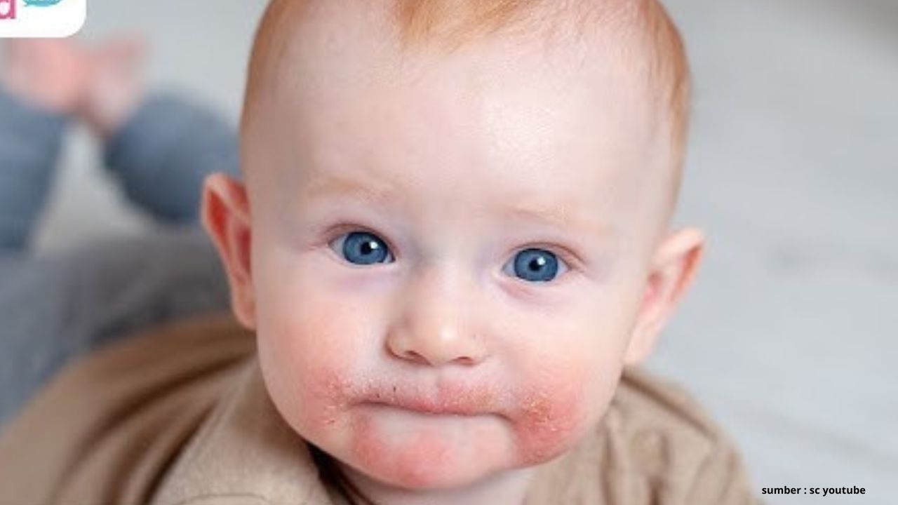 Catat! Ini 3 Bahan Alami yang Bisa Membantu Mengobati Penyakit Dermatitis Atopik