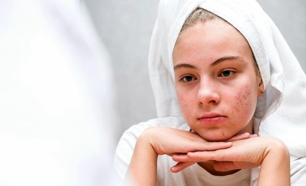  Jerawat yang Dianggap Sepele, Ternyata Berdampak Besar pada Mental Remaja