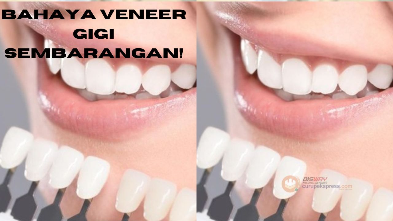 Bahaya Veneer Gigi Sembarangan yang Jarang Diketahui!