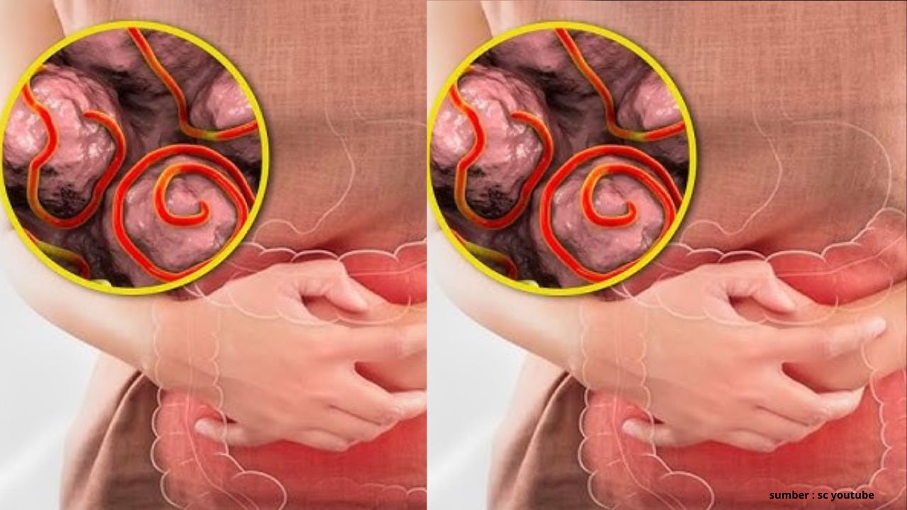 3 Bahan Alami yang Bisa Mengatasi Cacingan, Cek Disini!