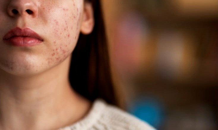 Kulit Breakout Tetap Butuh Sunscreen! Ini Alasan SPF 30 Lebih Direkomendasikan