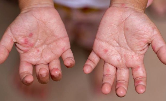  Masih Takut Memandikan Anak Cacar Air ? Ini Fakta Medisnya