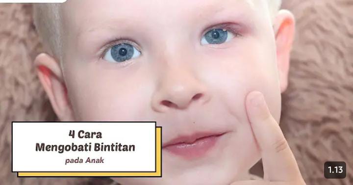 Cara Mengatasi Mata Bintitan Pada Anak