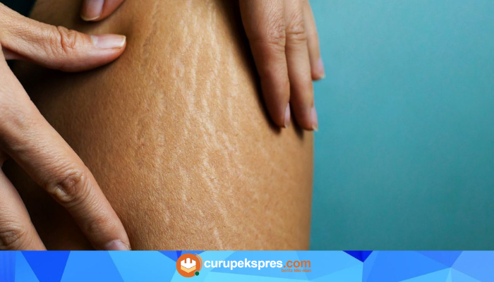 Mengungkap Fakta: Benarkah Stretch Mark Muncul Karena Digaruk?