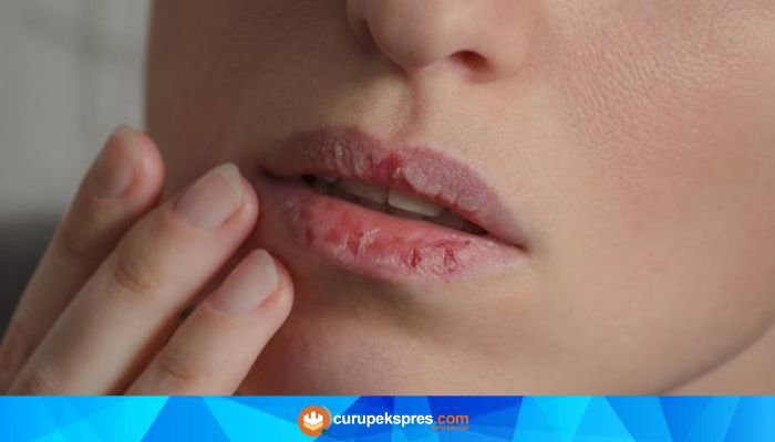 6 Cara Sederhana Mengobati Bibir Pecah-pecah secara Alami