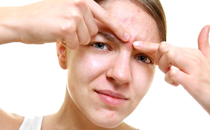  Jerawat Dahi Membandel Bisa Berasal dari Sampo, Ini Fakta yang Jarang Diketahui