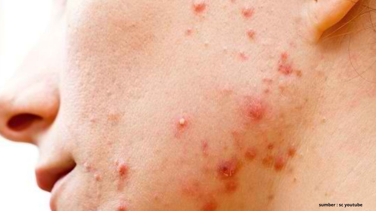 Kamu Harus Tahu! Ini 3 Buah yang Bisa Membantu Mengatasi Jerawat pada Wajah