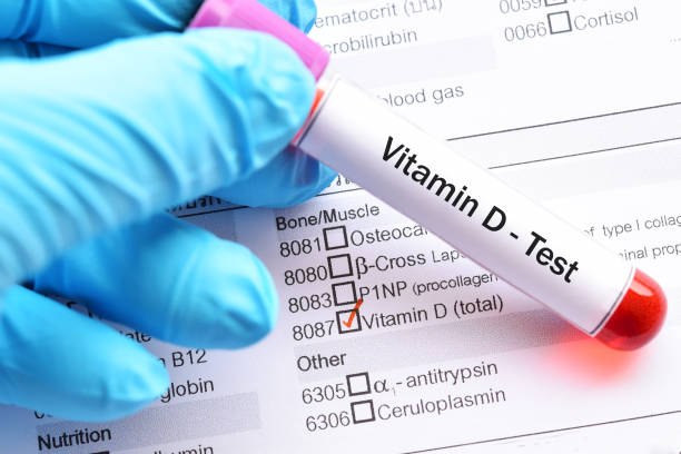 Kekurangan Vitamin D Sebabkan Gangguan Kesehatan Mental