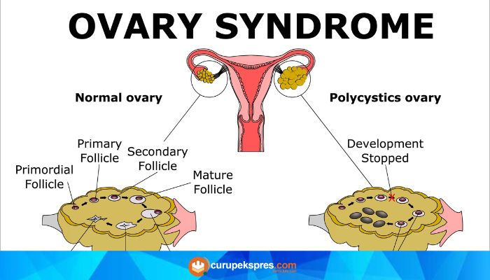 Tanda-Tanda Penyakit PCOS (Polycystic Ovary Syndrome): Kenali Gejala dan Pertimbangkan Tindakan Medis yang Tep