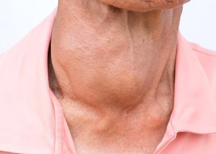  Jangan Anggap Sepele! Ini Tanda-Tanda Hipotiroid yang Perlu Diwaspadai