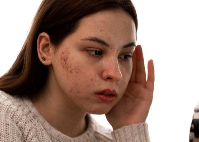 Kulit Berminyak dan Berjerawat ? Hindari 5 Bahan Ini agar Wajah Lebih Sehat