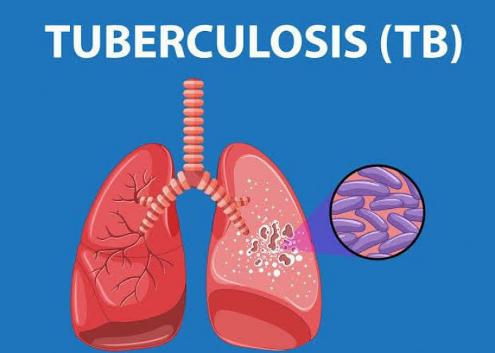 Jumlah Warga RL Terpapar Tuberkulosis Capai 198 Jiwa, Ini Penyebabnya!