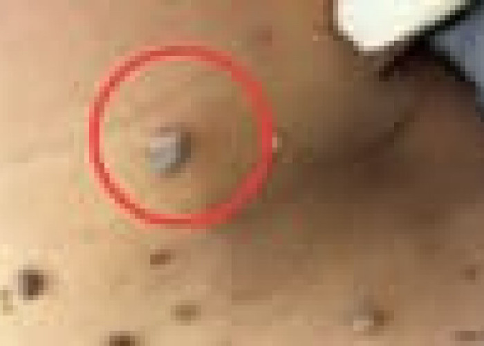 Atasi Kutil di Leher dengan Bahan Alami Ini