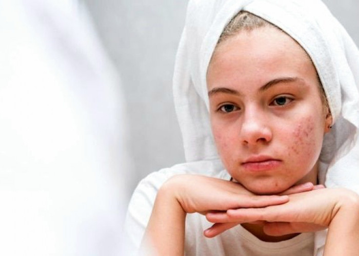  Jerawat yang Dianggap Sepele, Ternyata Berdampak Besar pada Mental Remaja