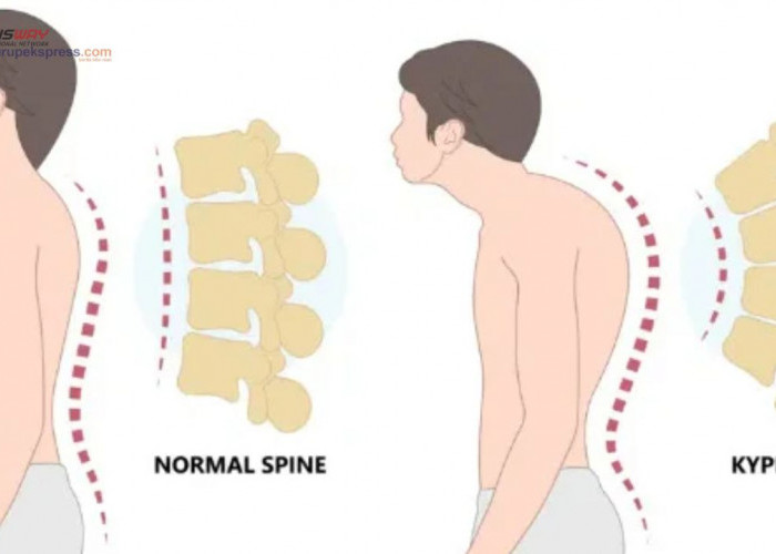 Jangan Diabaikan! Berikut Penyebab Kifosis yang Jarang Diketahui!