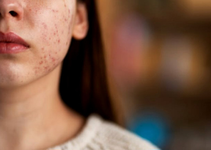 Kulit Breakout Tetap Butuh Sunscreen! Ini Alasan SPF 30 Lebih Direkomendasikan