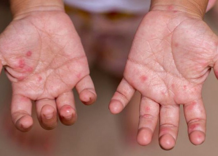  Masih Takut Memandikan Anak Cacar Air ? Ini Fakta Medisnya