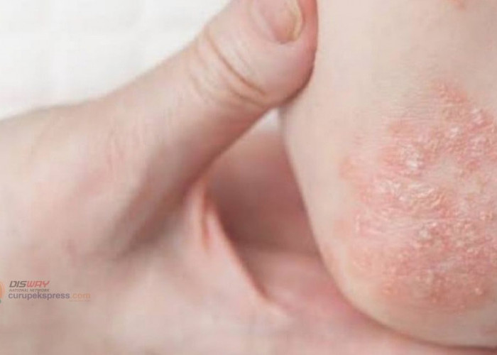 Penyebab Dermatitis yang Jarang Diketahui!