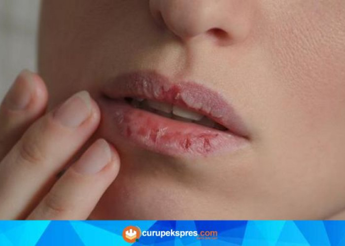 6 Cara Sederhana Mengobati Bibir Pecah-pecah secara Alami