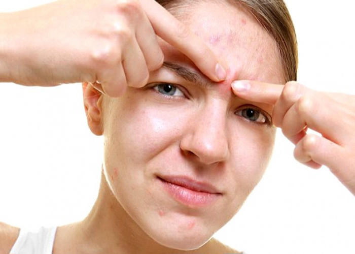  Jerawat Dahi Membandel Bisa Berasal dari Sampo, Ini Fakta yang Jarang Diketahui