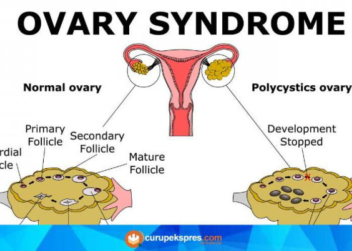 Tanda-Tanda Penyakit PCOS (Polycystic Ovary Syndrome): Kenali Gejala dan Pertimbangkan Tindakan Medis yang Tep