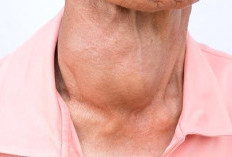  Jangan Anggap Sepele! Ini Tanda-Tanda Hipotiroid yang Perlu Diwaspadai