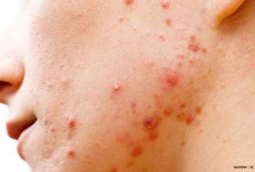 Tips Menghindari Maskne atau Jerawat Karena Penggunaan Masker