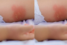 Tips Hilangkan Ruam Pada Bayi Karena Popok 