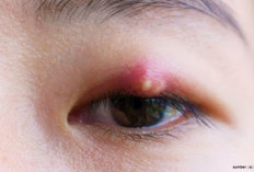 Penyebab Mata Bintitan yang Harus Kamu Ketahui