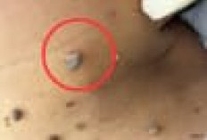 Atasi Kutil di Leher dengan Bahan Alami Ini