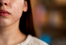 Kulit Breakout Tetap Butuh Sunscreen! Ini Alasan SPF 30 Lebih Direkomendasikan