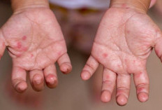  Masih Takut Memandikan Anak Cacar Air ? Ini Fakta Medisnya