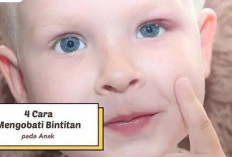 Ini Cara Mengatasi Mata Bintitan Pada Anak