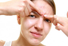  Jerawat Dahi Membandel Bisa Berasal dari Sampo, Ini Fakta yang Jarang Diketahui