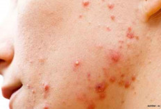 3 Buah Ini Bisa Membantu Mengatasi Jerawat pada Wajah